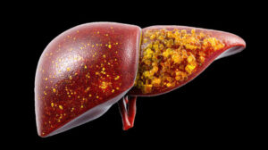 Leververvetting: oorzaken, symptomen en 7 bewezen tips om je lever te herstellen