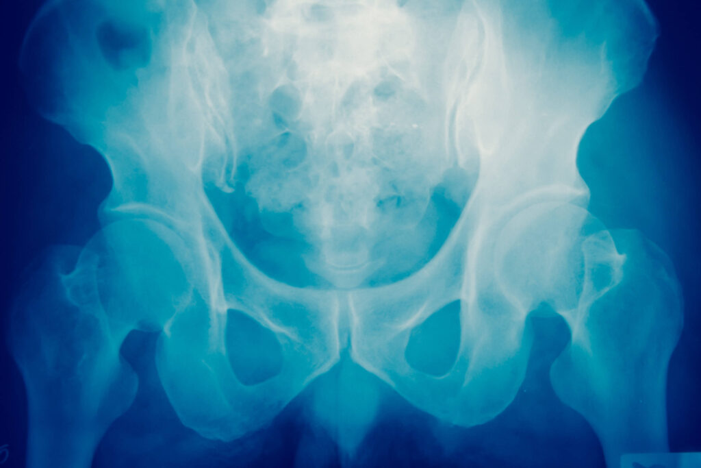 osteoporose