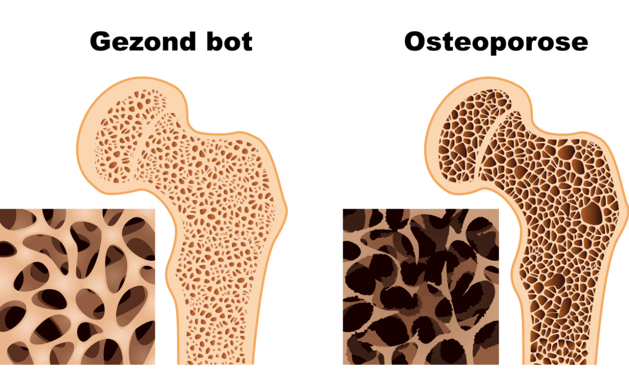 osteoporose