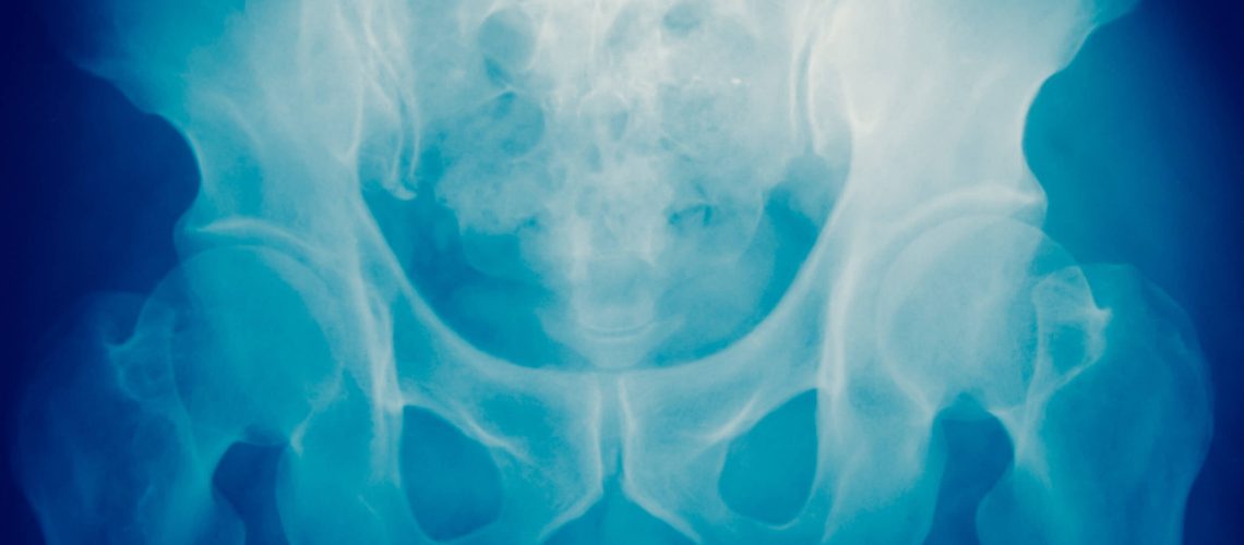 osteoporose